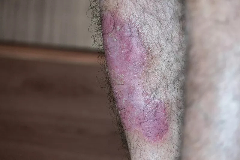 間充質干細胞成功治療斑塊狀銀屑?。喊咐芯? class=