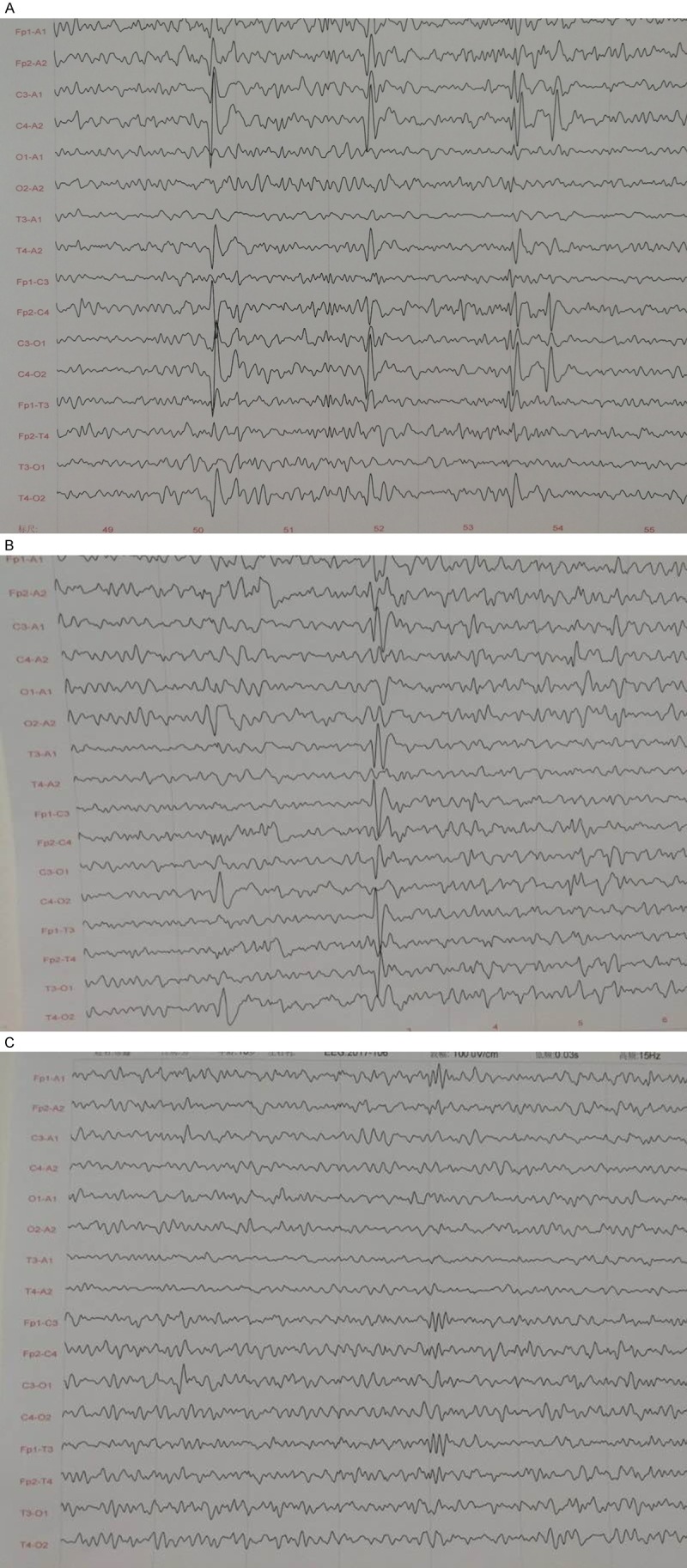 圖1：UC-MSC移植治療前后患者的腦電圖