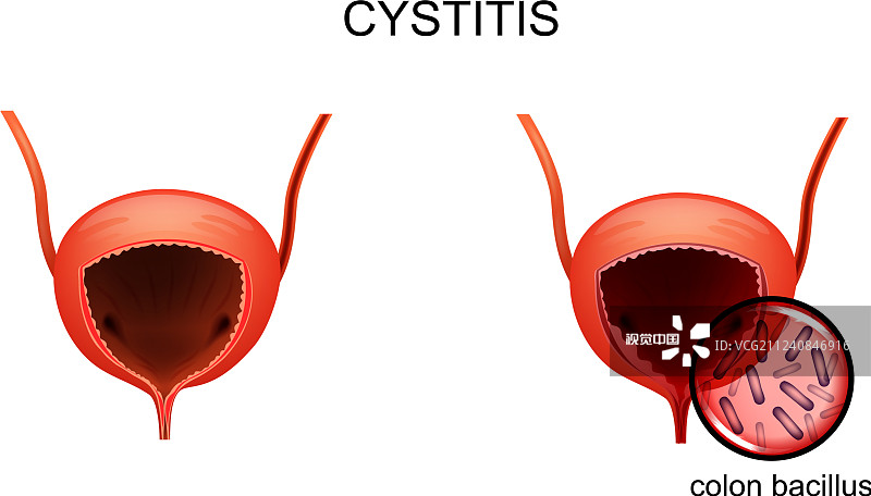 韓國首爾醫(yī)院公布：干細胞治療間質性膀胱炎的I期研究結果