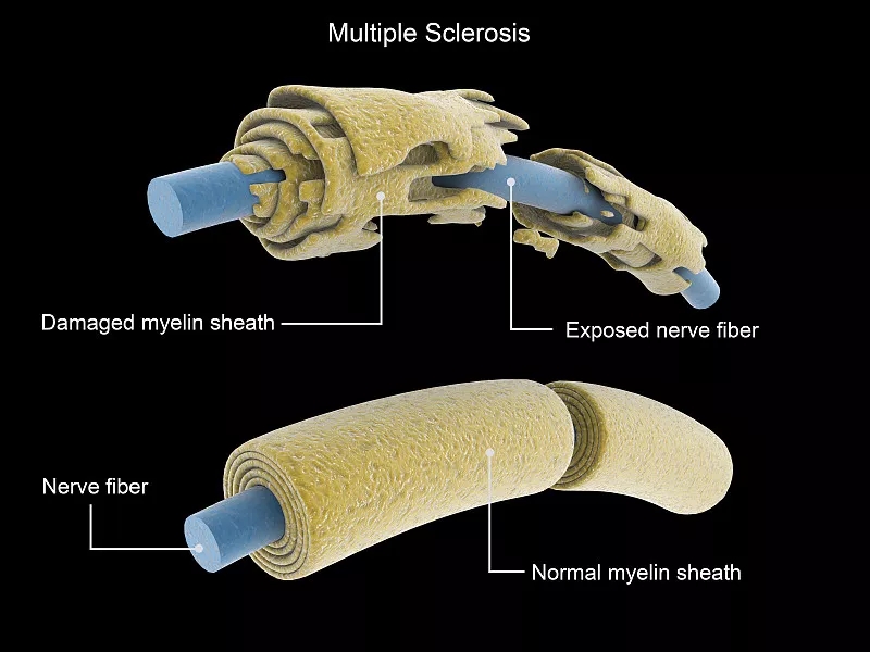 多發性硬化癥神經元與正常神經元的比較