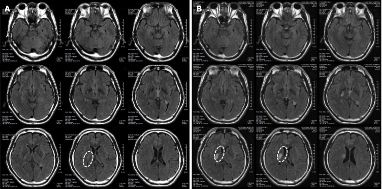 圖1：微創人臍帶間充質干細胞移植前患者的腦部計算機斷層掃描圖像。