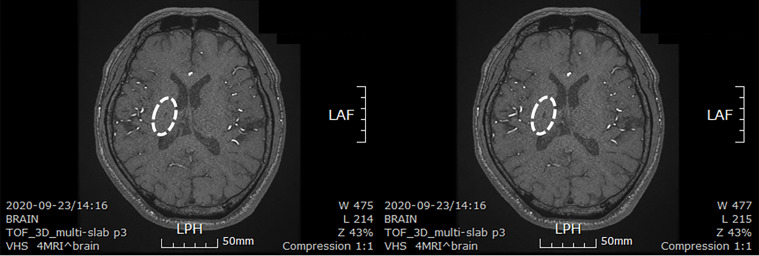 圖4：微創人臍帶間充質干細胞移植后患者的腦部計算機斷層掃描圖像。
