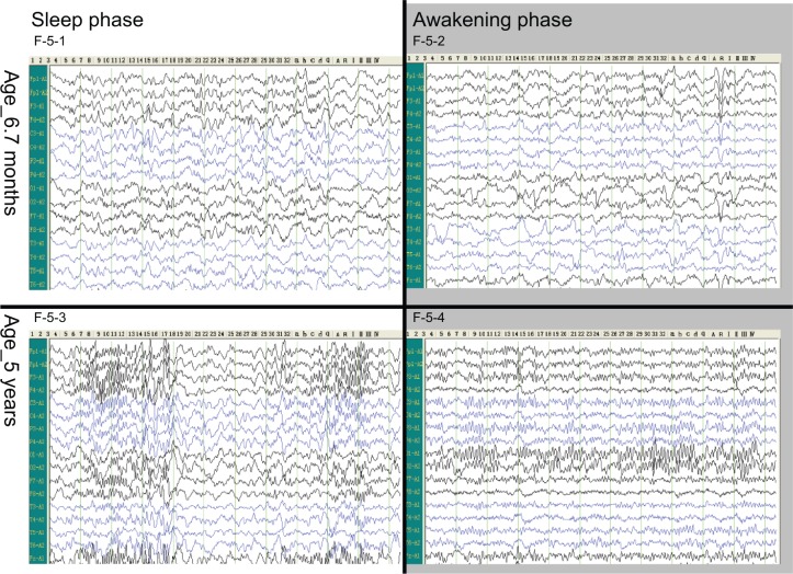 圖5:腦電圖。 圖5:腦電圖。