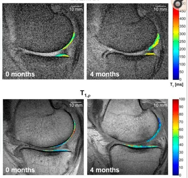 干細胞療法修復后疼痛顯著減輕，半月板軟骨質量提高。