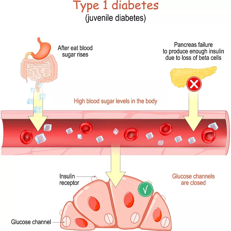 1型糖尿病癥狀有哪些？