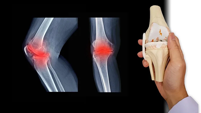 什么是骨關節(jié)炎-骨關節(jié)炎癥狀有哪些 什么是骨關節(jié)炎-骨關節(jié)炎癥狀有哪些