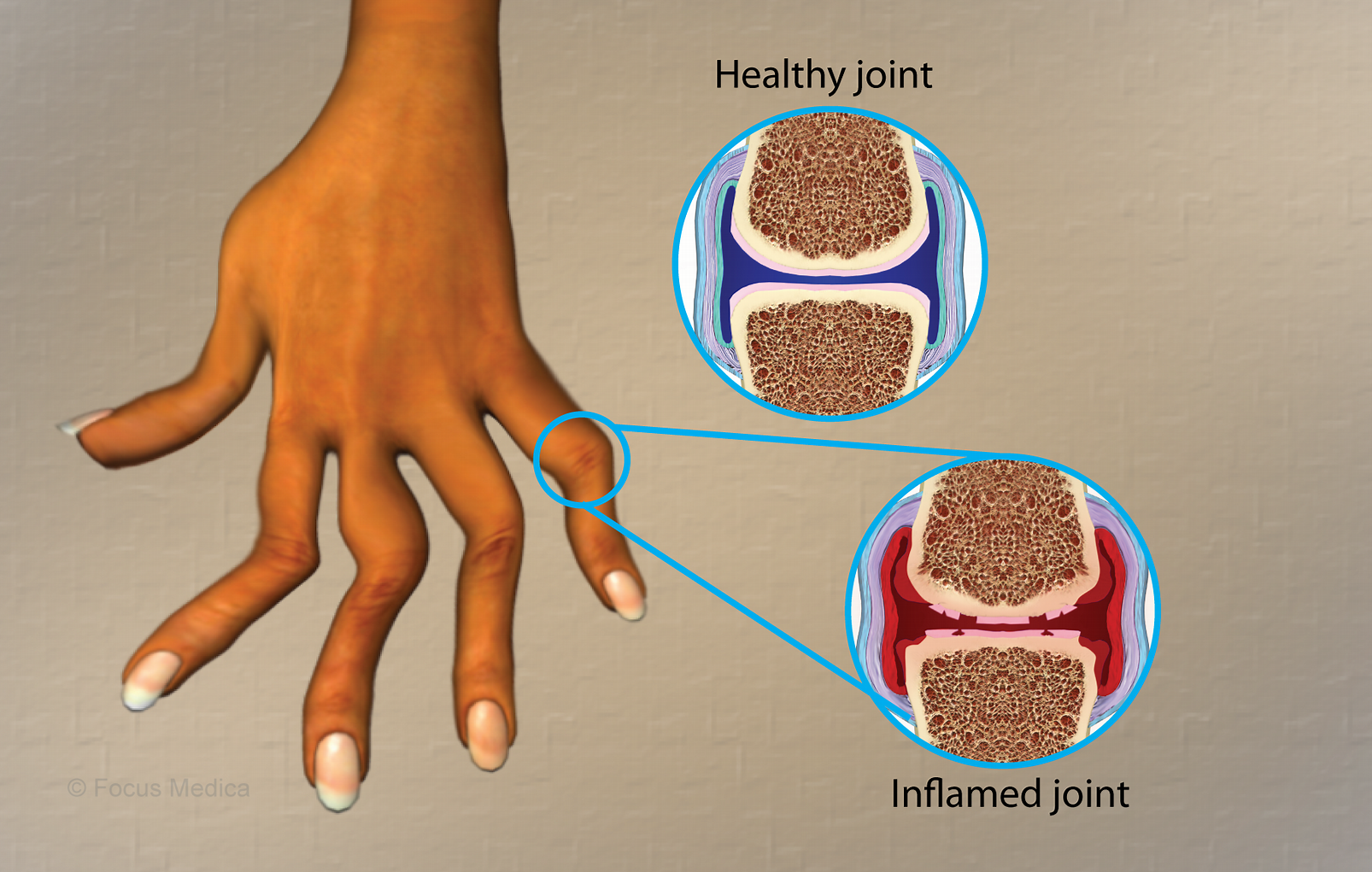 類風(fēng)濕關(guān)節(jié)炎是什么病