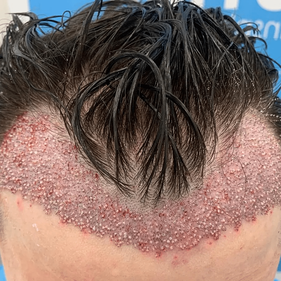 頭發移植手術后即刻的結果。——這允許在患者中建立更豐滿和更前的發際線