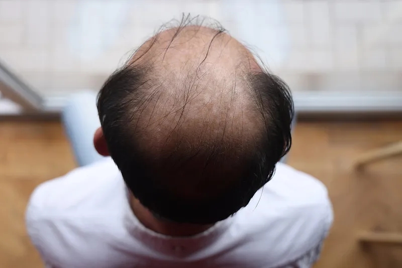 干細胞治療脫發的優缺點 干細胞治療脫發的優缺點