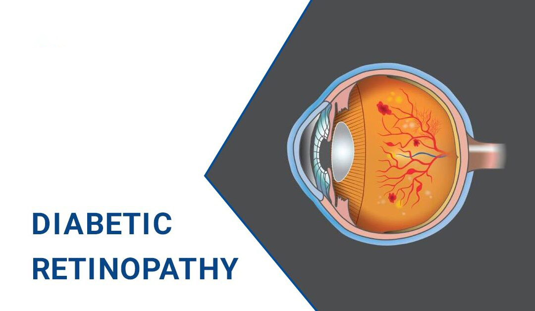 糖尿病視網膜病變–原因、階段和治療