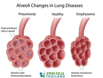 肺泡再生干細(xì)胞肺氣腫再生 肺泡再生干細(xì)胞肺氣腫再生