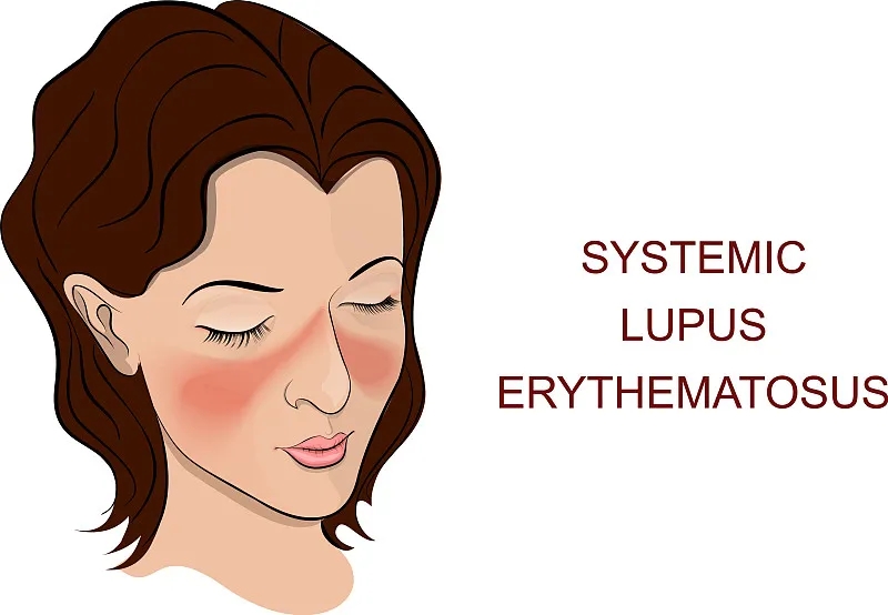 系統性紅斑狼瘡是一種自身免疫性疾病,其特征在于針對細胞核和細胞質抗原的自身抗體 系統性紅斑狼瘡是一種自身免疫性疾病,其特征在于針對細胞核和細胞質抗原的自身抗體