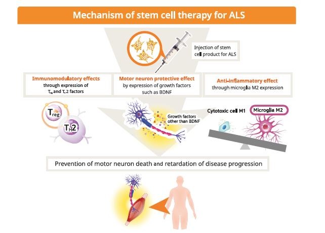 干細胞療法用于治療肌萎縮側索硬化癥（ALS）。