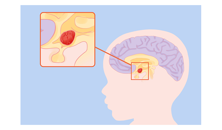 干細胞治療腦癱的成功率是多少？