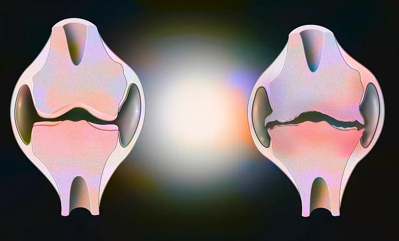 盤(pán)點(diǎn)：2020~2023年干細(xì)胞治療骨關(guān)節(jié)炎的臨床研究進(jìn)展