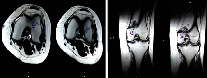 圖2：治療后MRI顯示內(nèi)側(cè)和外側(cè)半月板后角的撕裂有所改善。患者經(jīng)歷了癥狀改善以及進(jìn)行日常生活活動的能力增強(qiáng)。