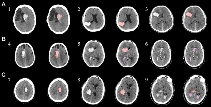 圖1：每個間充質(zhì)干細胞治療患者按組的原始非對比計算機斷層掃描和分割結果
