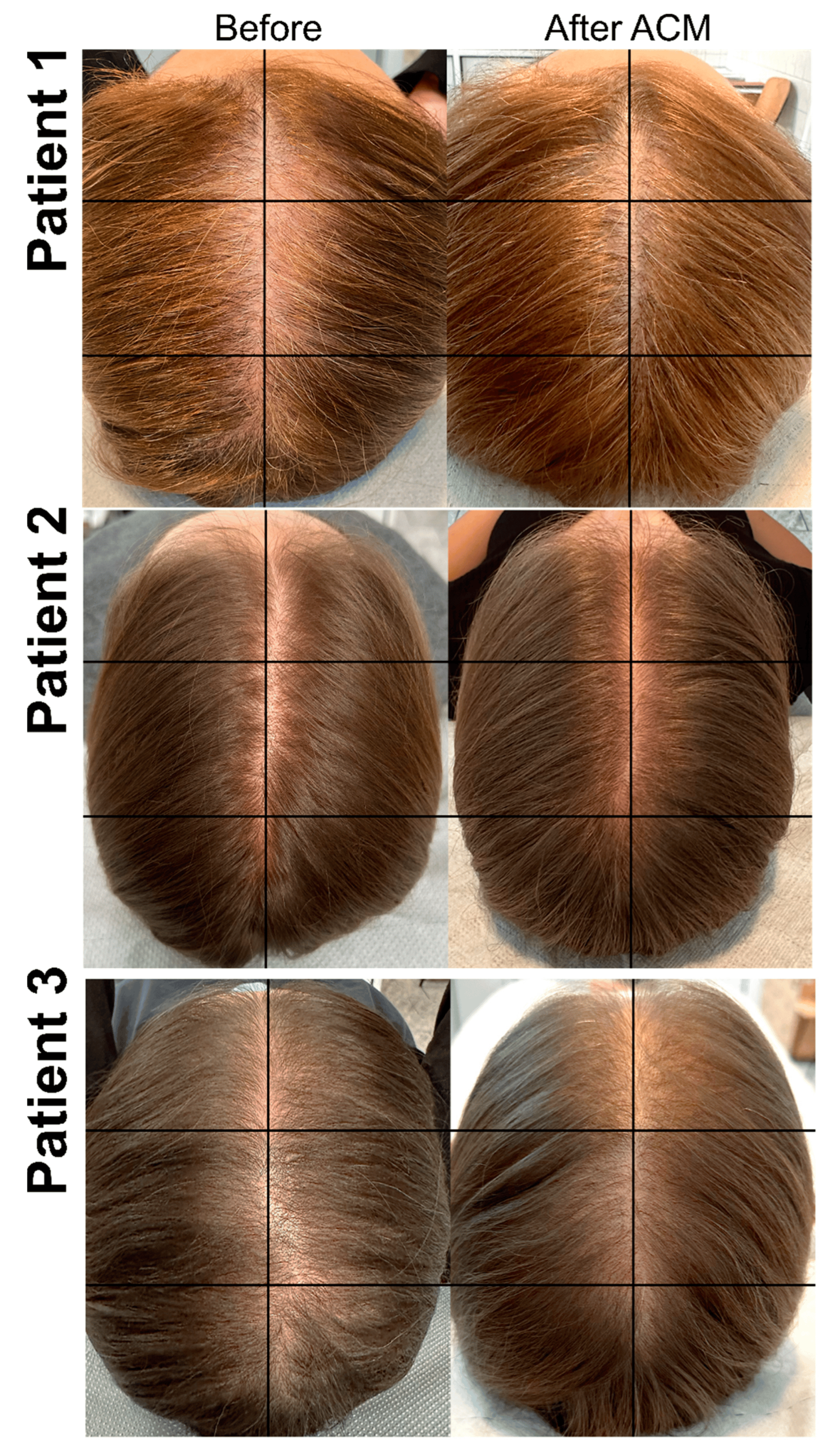 圖2：ACM治療前和治療后AGA患者樣本的照片。