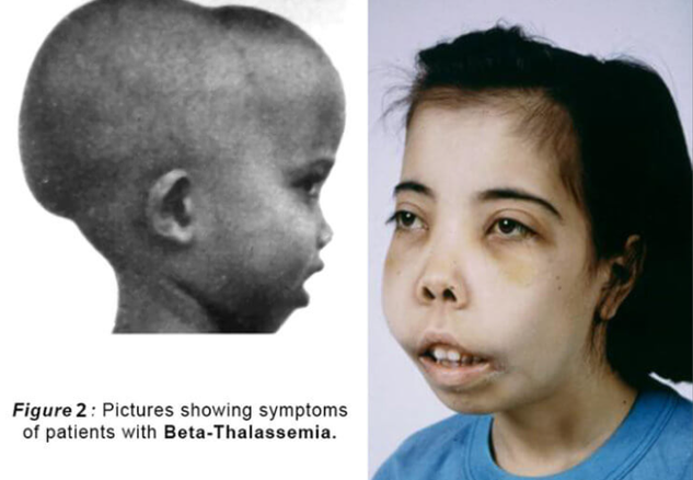 重型β地中海貧血是一種嚴重的遺傳性疾病，給患兒帶來了長期的痛苦和折磨