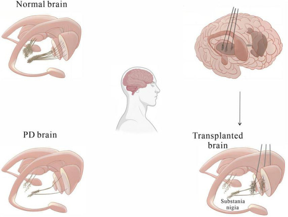 圖2：基本圖顯示細胞移植療法如何緩解帕金森病患者的運動癥狀。