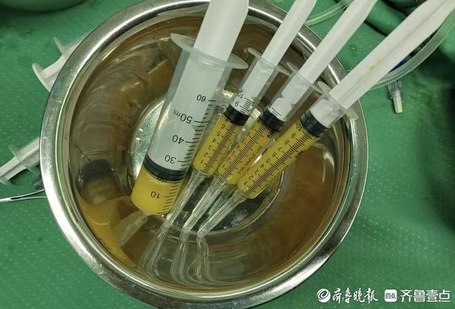 孫濤主任采用的自體脂肪微片段治療術，為她的治療帶來了新的轉機