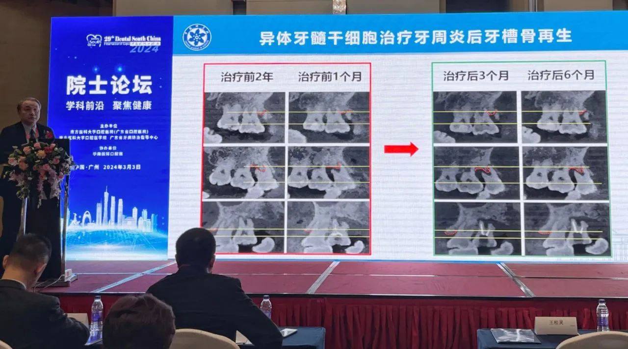 異體牙髓干細胞治療牙周炎后牙槽骨再生