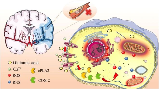 高血壓、高脂血癥、高同型半胱氨酸血癥、高血糖、吸煙和酗酒等危險因素都可能引發(fā)缺血性中風(fēng)的發(fā)生。