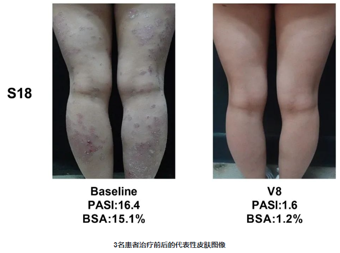 患者治療前后的代表性皮膚圖像