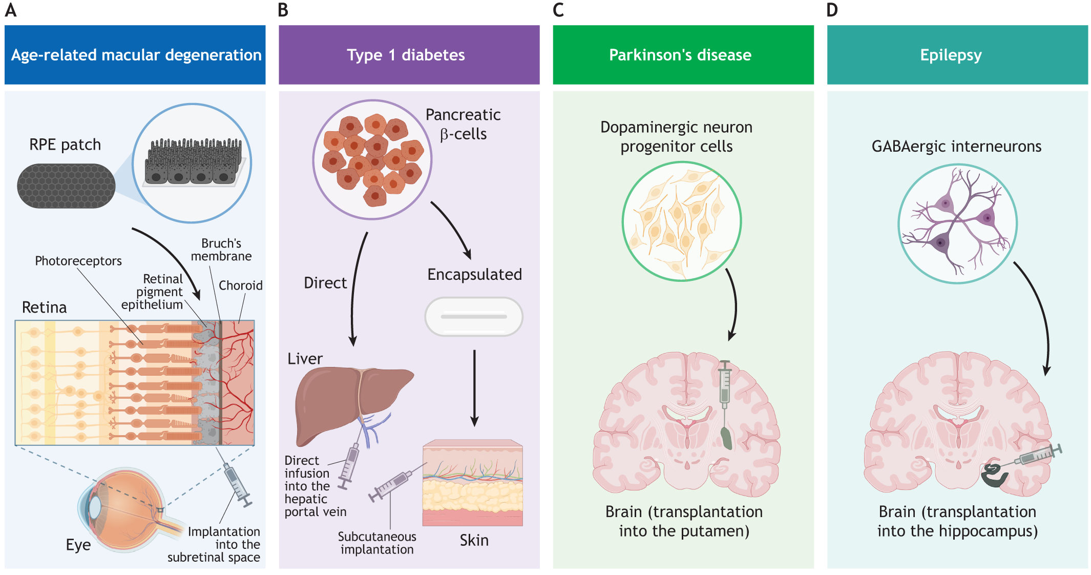 圖2：使用hPSC衍生細(xì)胞產(chǎn)品進(jìn)行開(kāi)創(chuàng)性臨床試驗(yàn)時(shí)所涉及的細(xì)胞類型和注射部位的圖示。