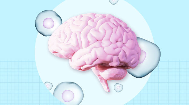 早期數(shù)據(jù)表明干細胞療法可以“重置帕金森病的時鐘”