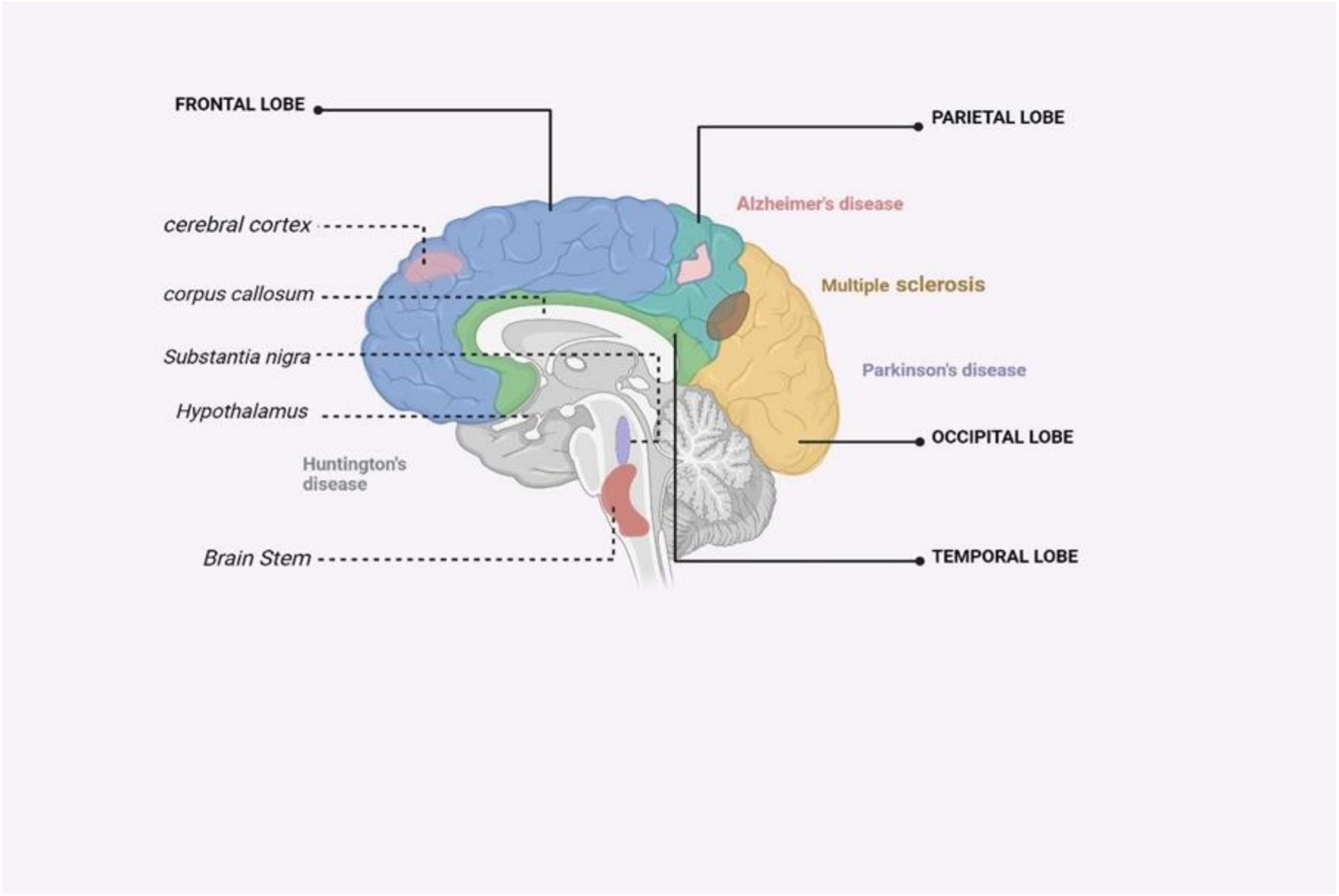圖4：受主要神經退行性疾病影響的大腦區域的圖解摘要