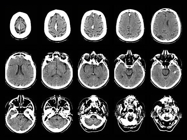 老年神經系統會出現哪些問題？