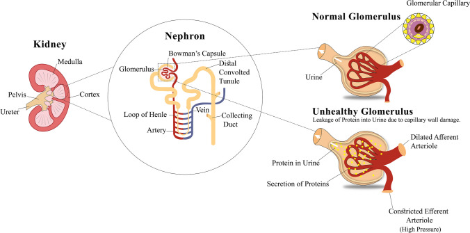圖1：導致糖尿病腎病的原因，即糖尿病引起的腎臟疾病