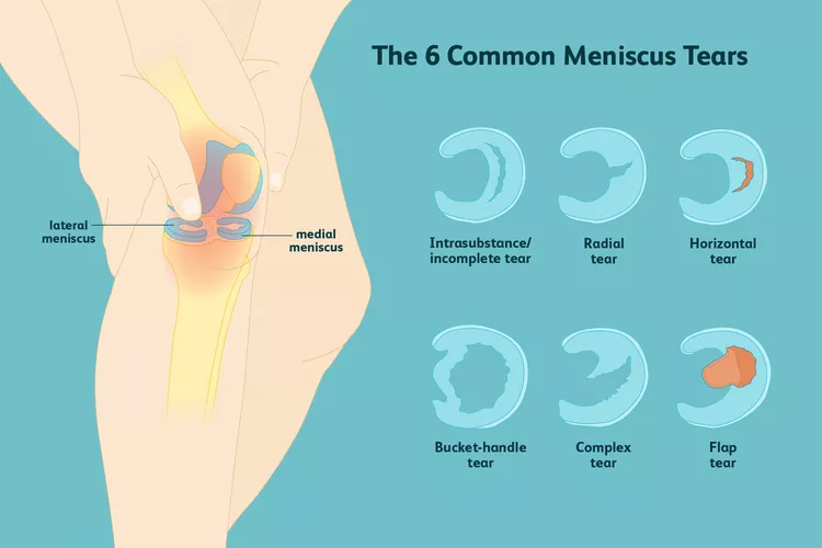膝關節(jié)半月板損傷：你了解這六種撕裂類型嗎？