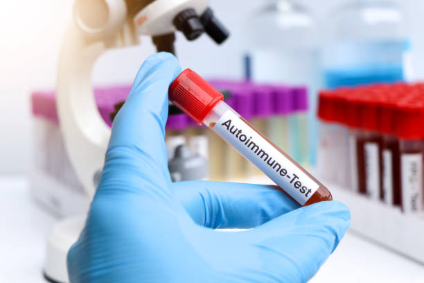 干細胞在類風濕關節炎、系統性紅斑狼瘡、銀屑病等自身免疫性疾病中的治療作用 干細胞在類風濕關節炎、系統性紅斑狼瘡、銀屑病等自身免疫性疾病中的治療作用