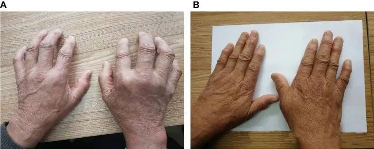 一名68歲男性被診斷患有類風濕性關節炎治療前后對比 一名68歲男性被診斷患有類風濕性關節炎治療前后對比