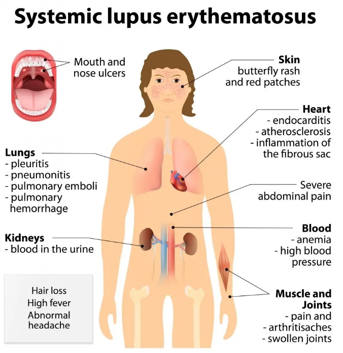 什么是系統性紅斑狼瘡？干細胞治療系統性紅斑狼瘡的臨床案例有哪些?