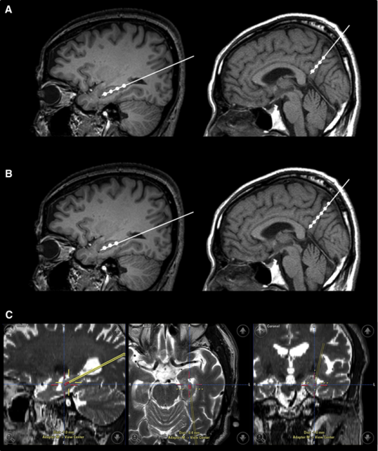 干細(xì)胞立體定向注射患者的右海馬體和右前丘盤