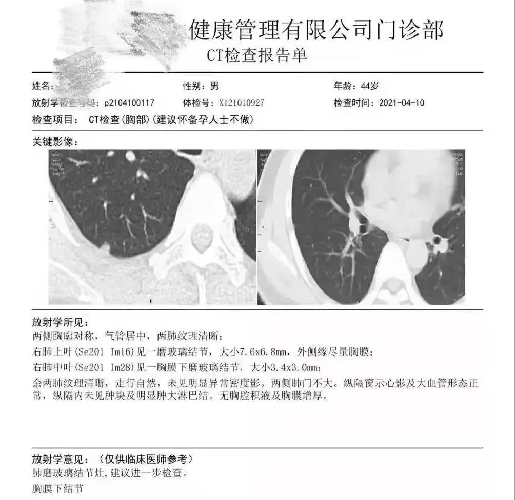 結果發(fā)現(xiàn)王先生右肺胸膜表面下（肺的內部），存在兩枚磨玻璃結節(jié)，其中較大者直徑7.6mm。