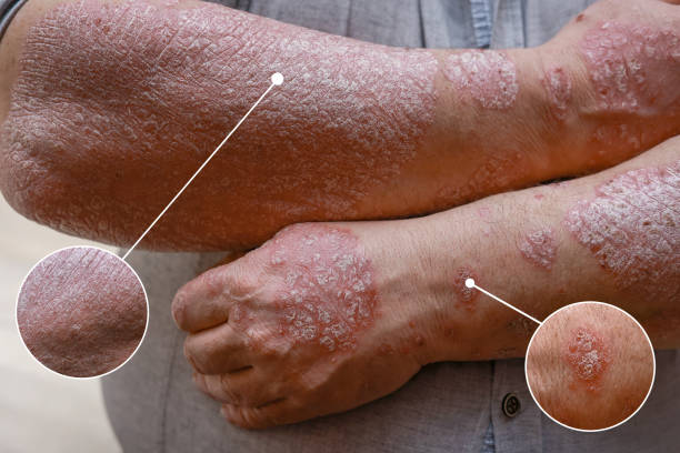 銀屑病治療新策略：干細胞治療銀屑病的臨床應用與效果評估