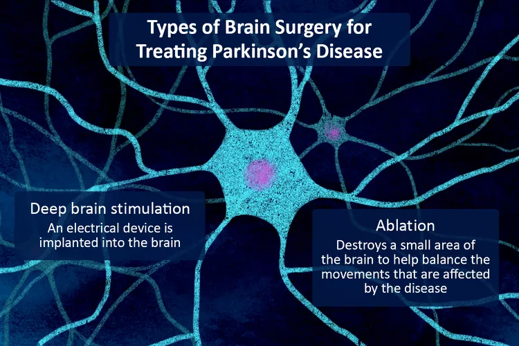 帕金森病的腦部手術(shù)：類型、恢復(fù)和風(fēng)險(xiǎn)
