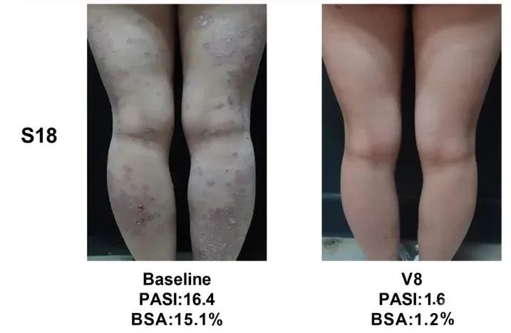 總共47.1% (8/17)的銀屑病患者在PASI（皮損面積和嚴(yán)重程度）評分中有至少40%的改善
