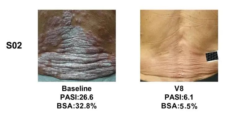 總共47.1% (8/17)的銀屑病患者在PASI（皮損面積和嚴(yán)重程度）評分中有至少40%的改善