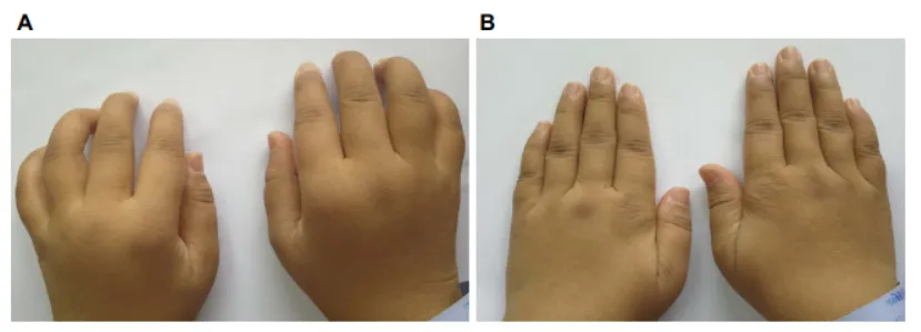 33歲女性，患病4年，治療前后對比