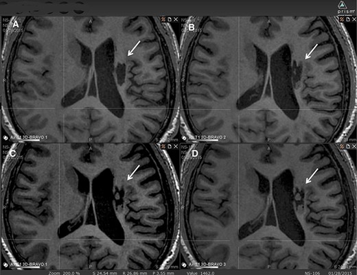 圖2：腔內組織生長的縱向MRI示例。