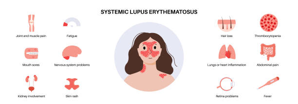 紅斑狼瘡會對患者壽命造成影響嗎? 紅斑狼瘡會對患者壽命造成影響嗎?