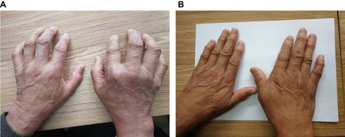 （圖1A）表現為雙手不能伸直。

（圖1B）治療3年后，停用抗風濕藥物5年，雙手伸展自如，關節周圍風濕結節逐漸變軟、消退。