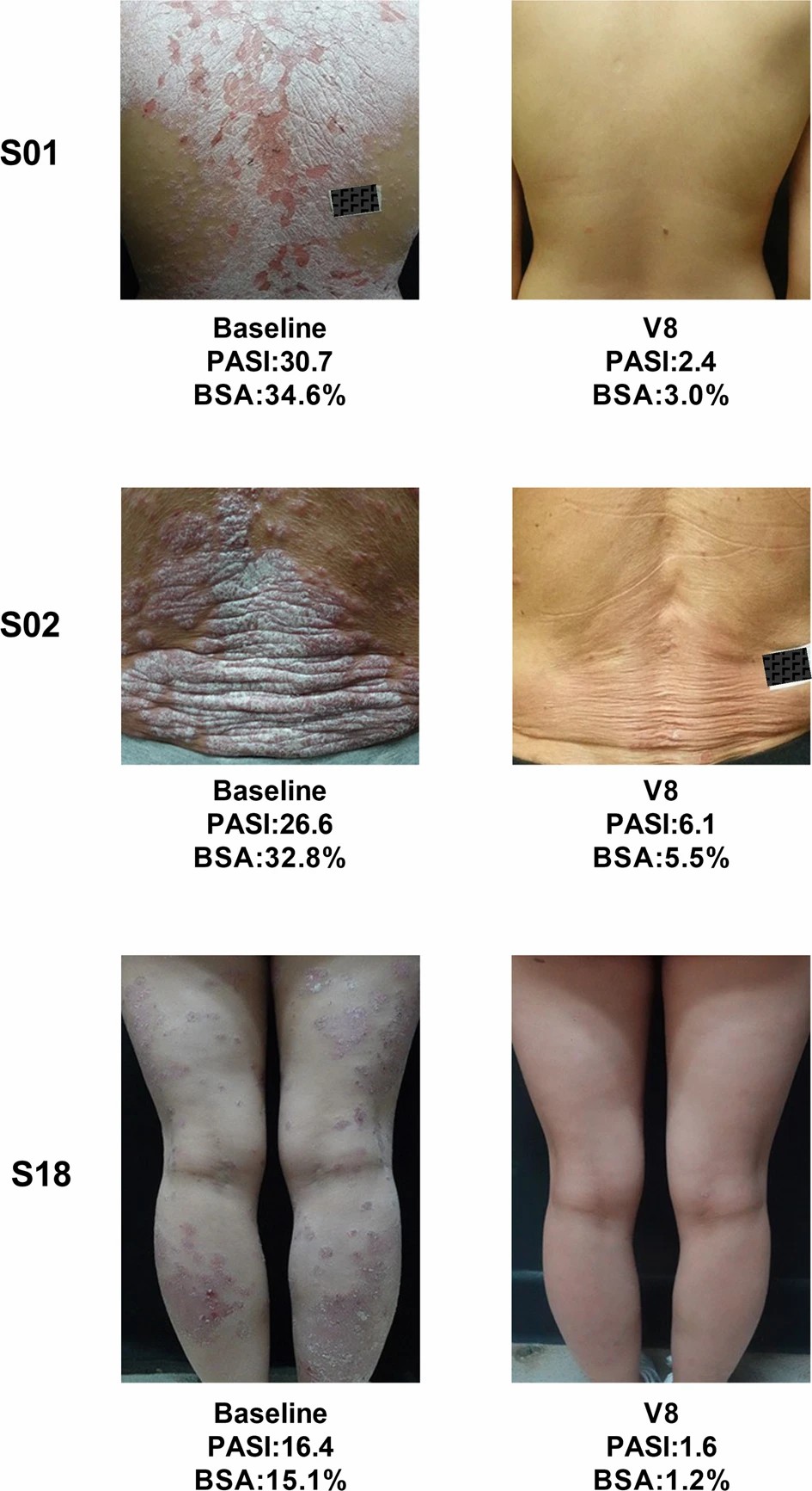 三名患者經(jīng)過治療后根據(jù) PGA 評分顯示無疾病跡象（評分為 0）或輕微疾病（評分為 1）。