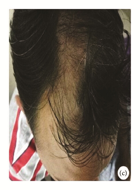 局部應(yīng)用骨髓間充質(zhì)干細(xì)胞一個月后，銀屑病消退，炎性紅斑完全清除（c）。