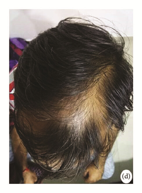 局部應(yīng)用骨髓間充質(zhì)干細(xì)胞一個月后，銀屑病消退，炎性紅斑完全清除（d）。